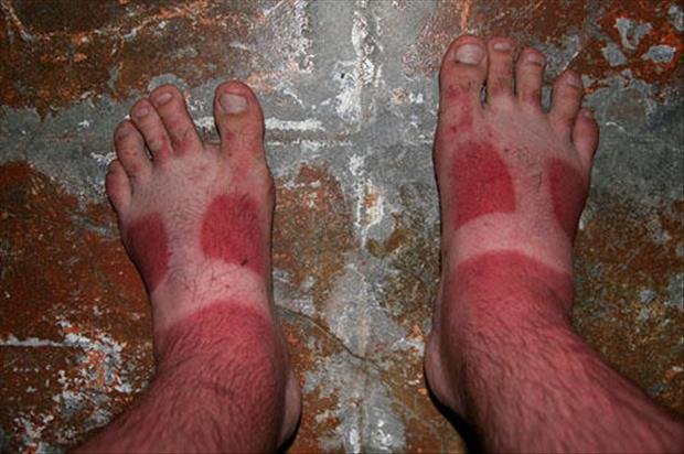 sunburn-pictures-dumpaday-15