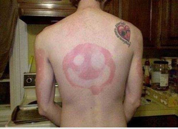 sunburn-pictures-dumpaday-9